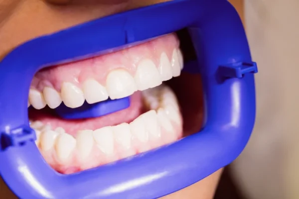 female_patient_receiving_dental_treatment_1